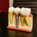 Sinus lift pentru implant dentar