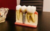 Sinus lift pentru implant dentar
